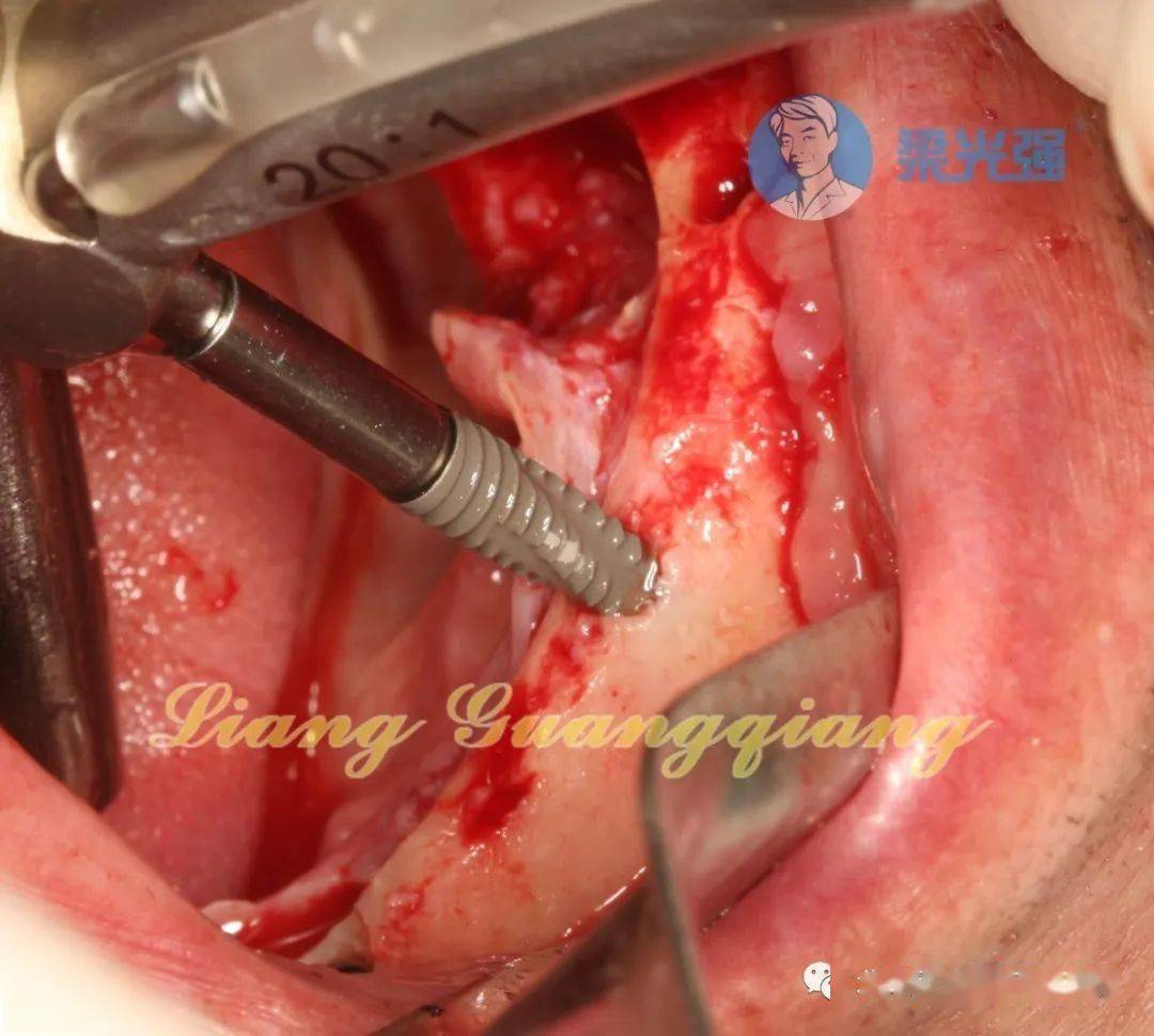 双侧均暴露颏孔,这样就不用担心损伤到颏神经了.