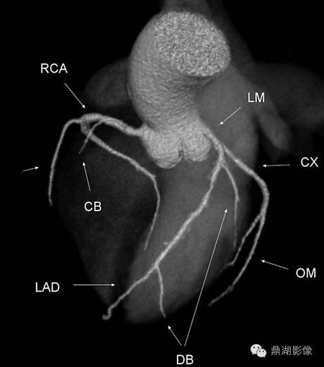 一篇文章解决冠脉cta解剖(必点收藏)