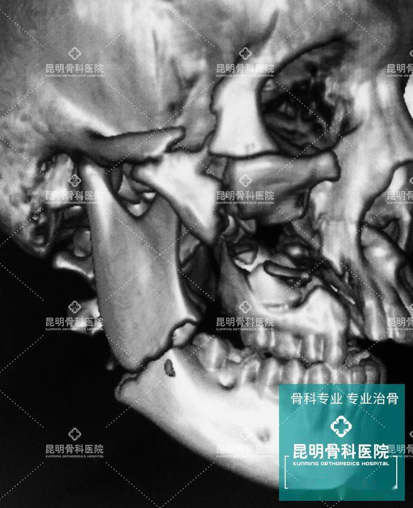 昆明骨科醫院花季少年面部塌陷醫生妙手重塑新臉