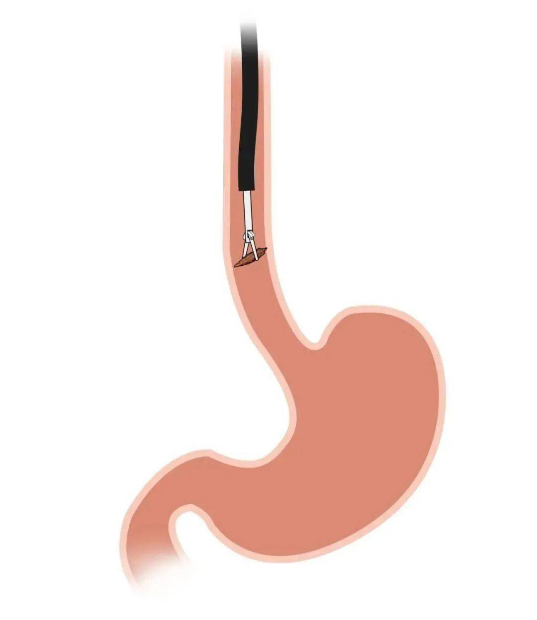 警惕祸从口入金乡县接连2例熊孩子误吞异物