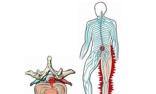 针刀治疗坐骨神经痛疗效好