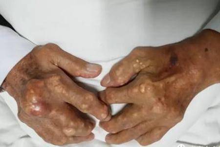 如果出现了这些症状当心痛风恶化