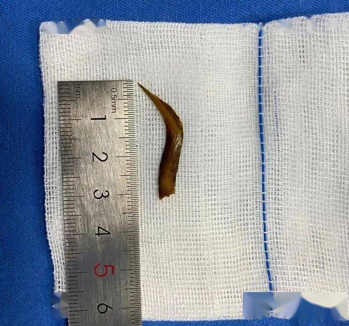 开颅 开腹!杭州大伯1年内2次手术,都因为这一根鱼刺