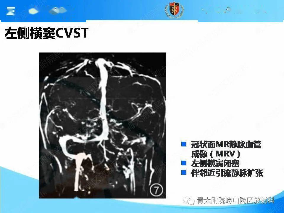 脑静脉窦血栓形成的影像学诊断及预后评估