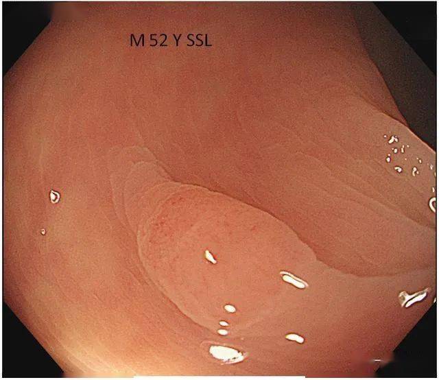 侧向发育型肿瘤直肠管状腺瘤以下我挑几张有代表性,又不太吓人的图片