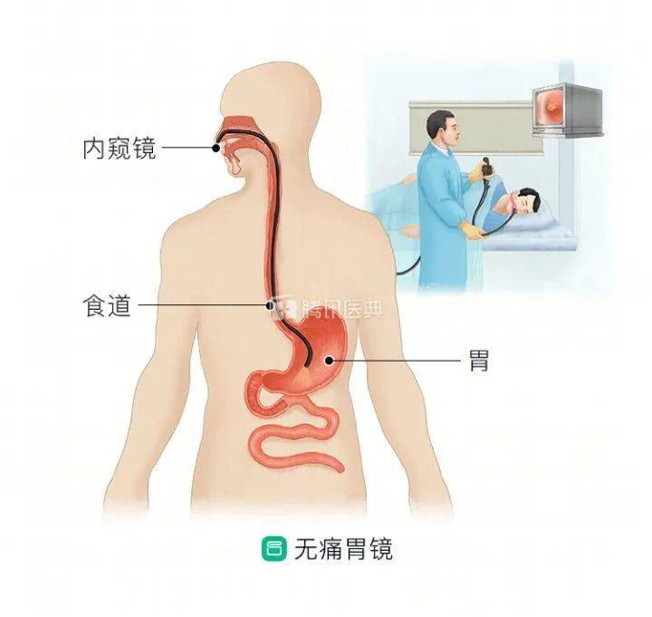 体检小百科:胃镜检查科普介绍