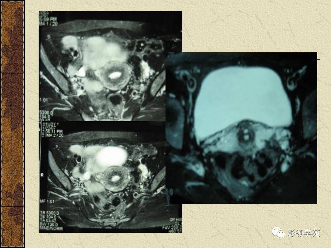 mri是盆腔脏器病变显示的最佳选择 mri的优势  1