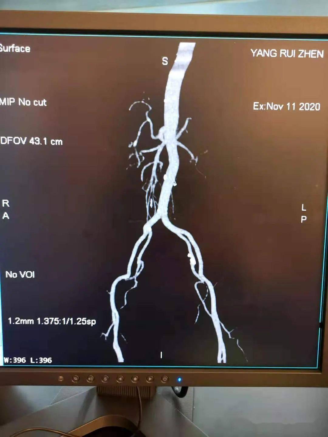 鹤庆县人民医院放射科带您了解腹部cta检查