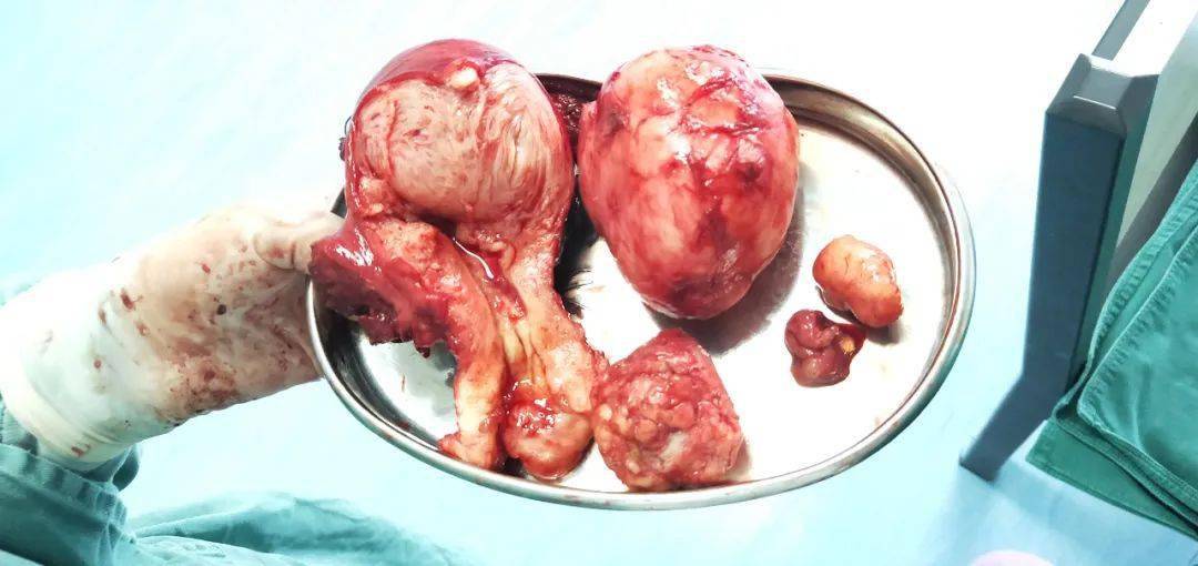 子宫口肌瘤图片图片