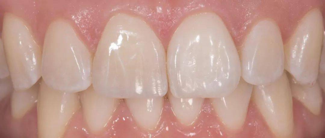 病例分享中切牙的修复复合树脂直接修复vs全瓷贴面修复