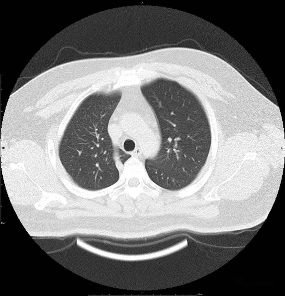 奇叶肺图片图片