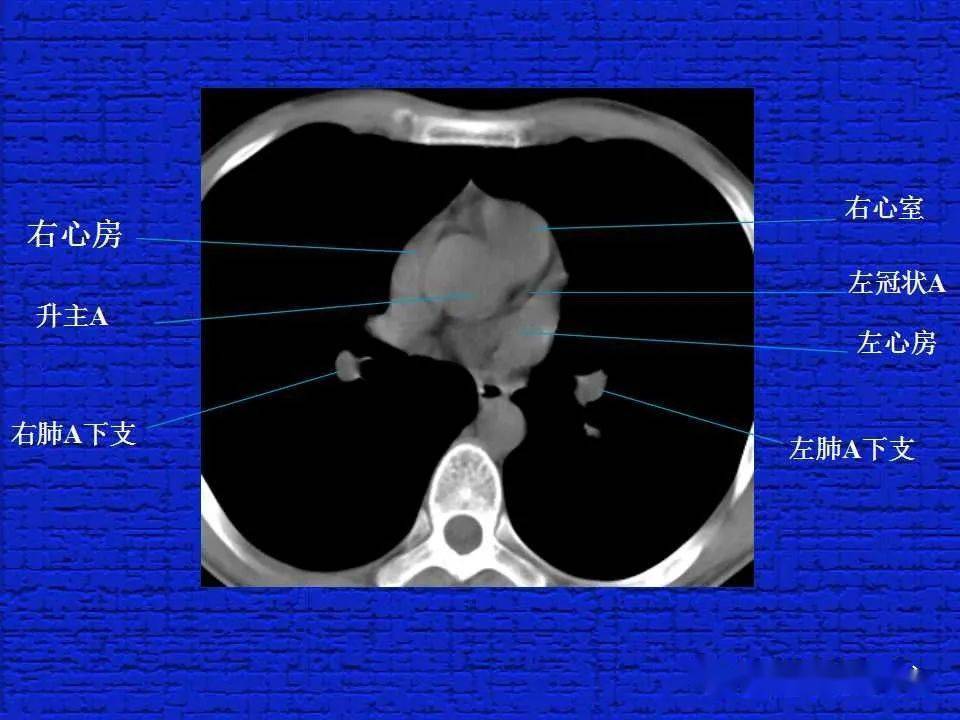 结合解剖谈正常胸部ct读片