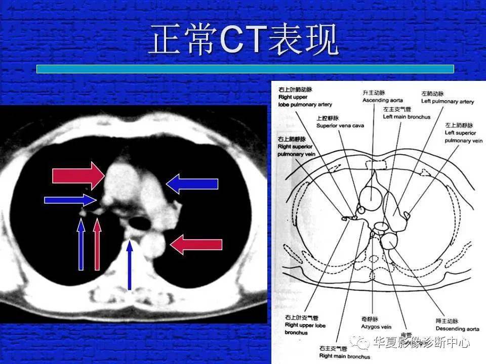 结合解剖谈正常胸部CT读片-搜狐大视野-搜狐新闻
