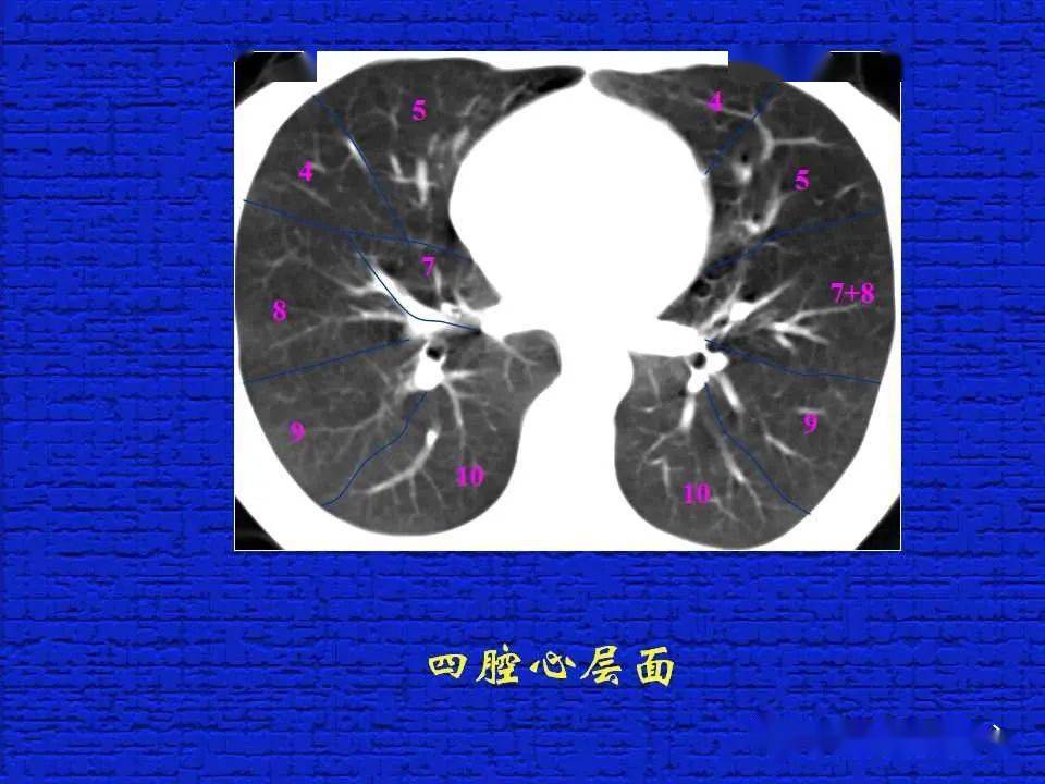 结合解剖谈正常胸部CT读片-搜狐大视野-搜狐新闻