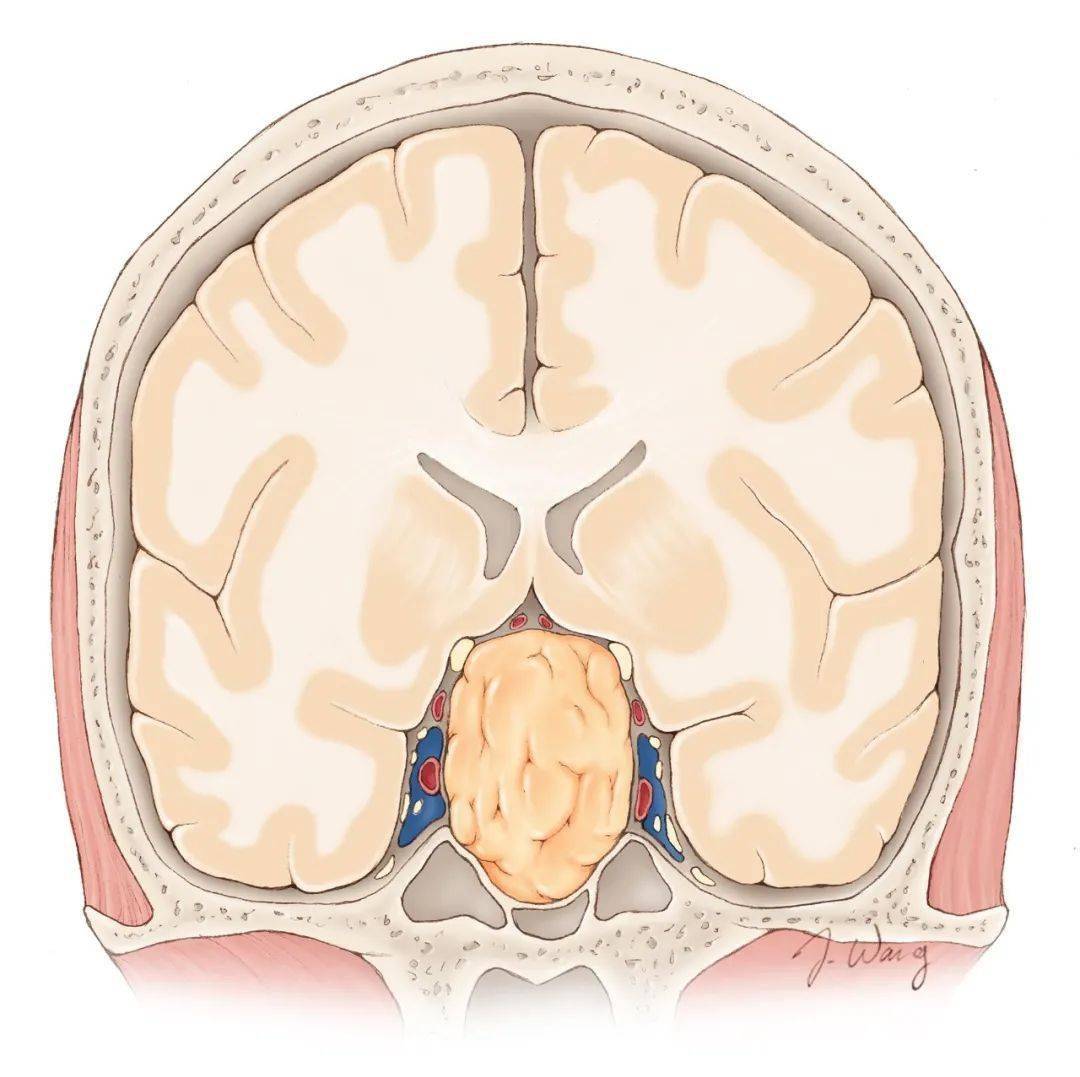 垂体微腺瘤:偏向垂体一侧按有无分泌激素,可分为功能性垂体腺瘤和非
