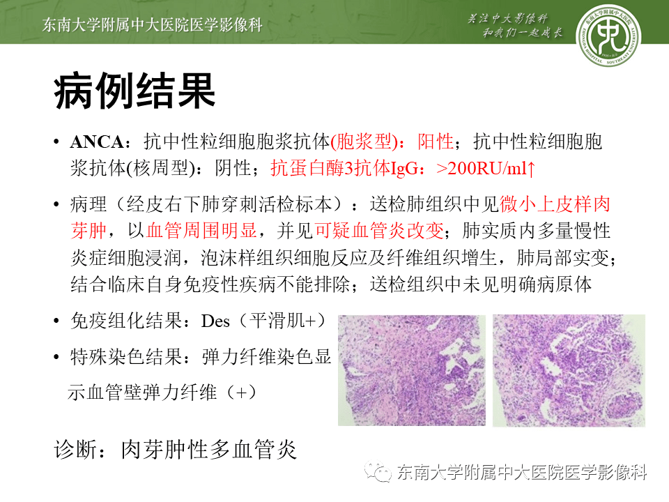 11.27 呼吸系統疾病——肉芽腫性多血管炎