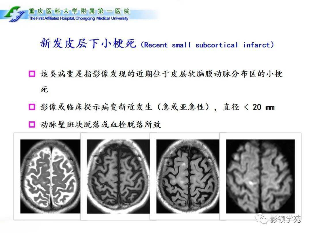 脑小血管病的影像学诊断