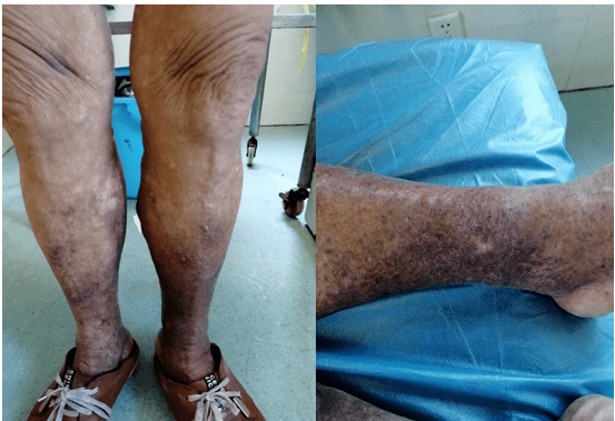 打打针就搞定泡沫硬化治疗下肢静脉曲张