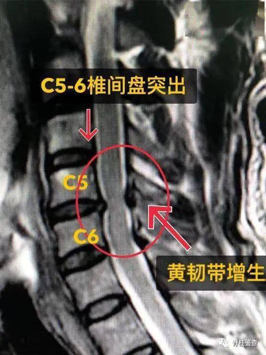 颈5-6椎间盘突出,黄韧带增生影像资料中年男性,术前颈椎过伸伤,脊髓