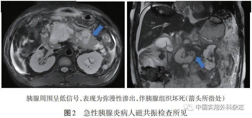 專題筆談影像學在膽源性胰腺炎診治中價值及評價