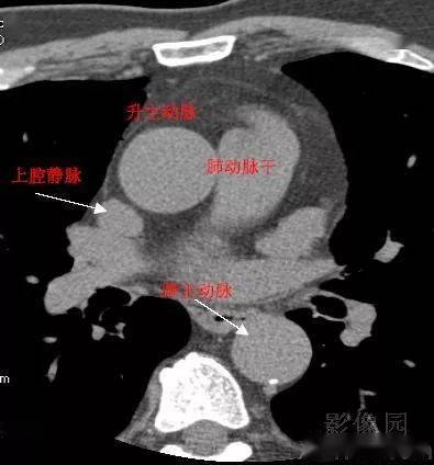 影像解剖 | 心脏冠状动脉CT解剖中文详细标注(图文)_相册