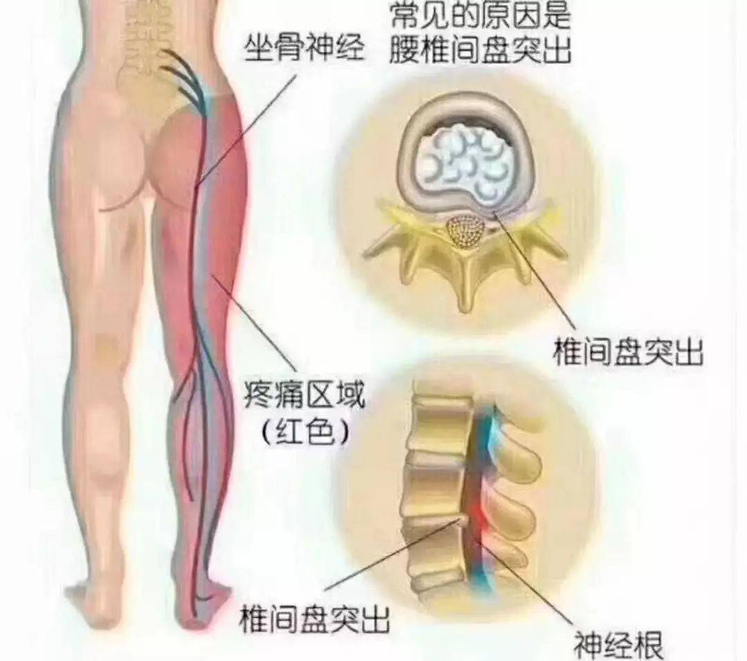 腰间盘突出怎么调理