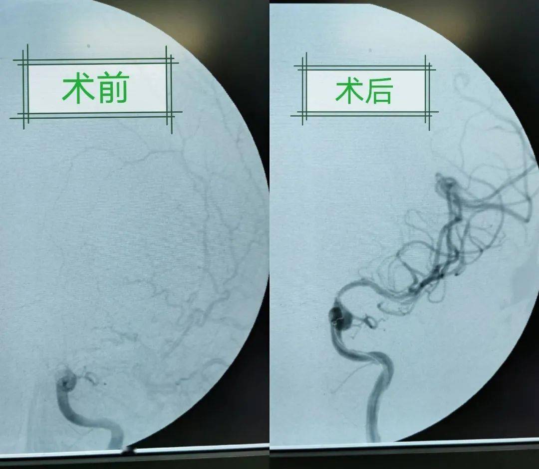 腦病科技術高精尖介入手術治療腦血栓我院成功完成首例顱內動脈支架