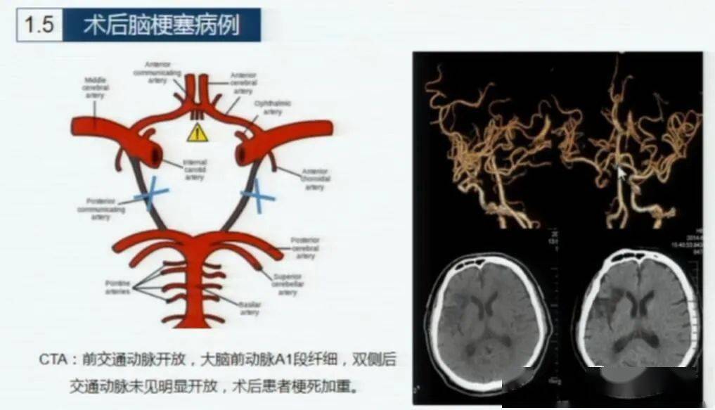 上圖10,cta示通過左側前交通動脈向右側供血,對側a1纖細,對側頸內動脈