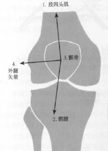 內側支持帶拉緊,並牽拉髕骨進入股骨滑車髁間