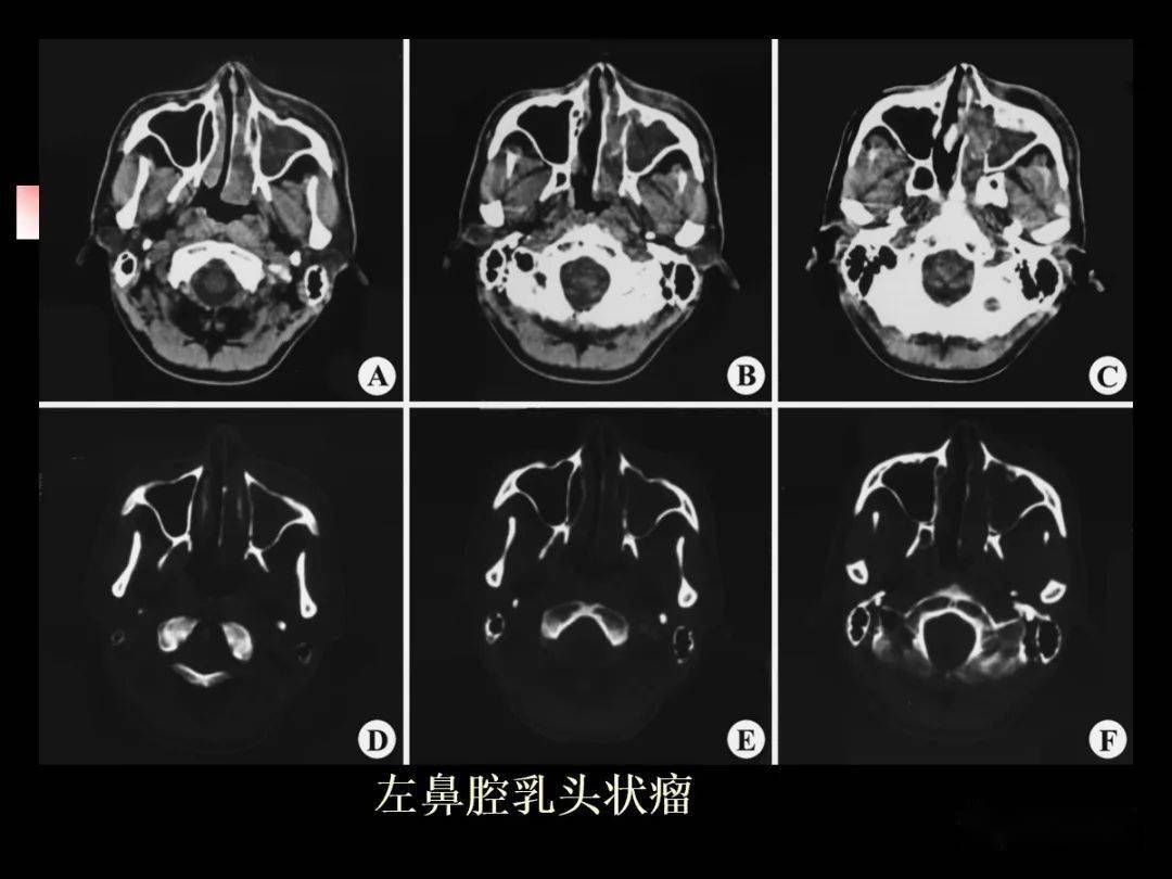 鼻及鼻竇影像解剖及相關疾病影像診斷