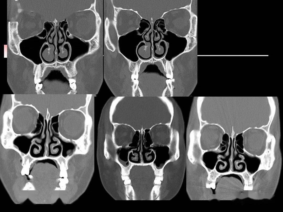 鼻窦x线解剖图片图片