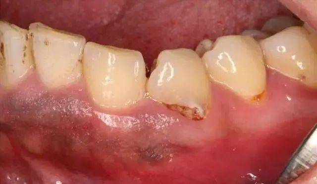 牙齿和牙龈之间有条黑色的线不是小事你需要到口腔科就诊了