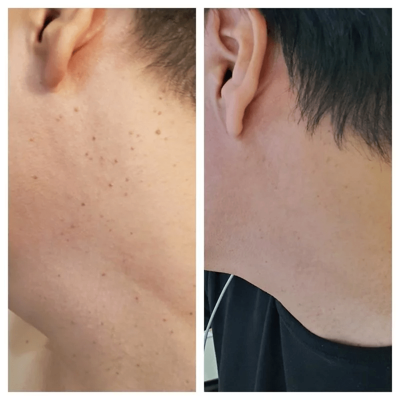 有效安全的祛痣方法,用co2激光对皮肤内色素的消除功能来实现对痣的