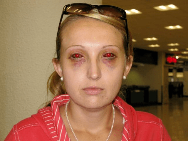 专家解答隐形眼镜和近视眼手术对潜水的影响