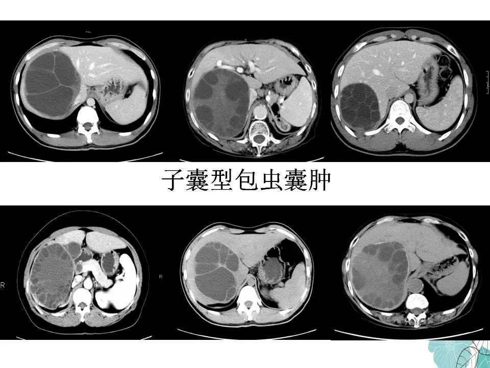 包虫病恐怖图片自己图片