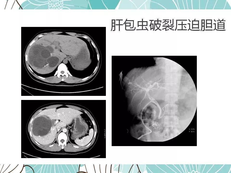 【每日一例1212】肝包虫病:54岁男,腹痛,肝区不适