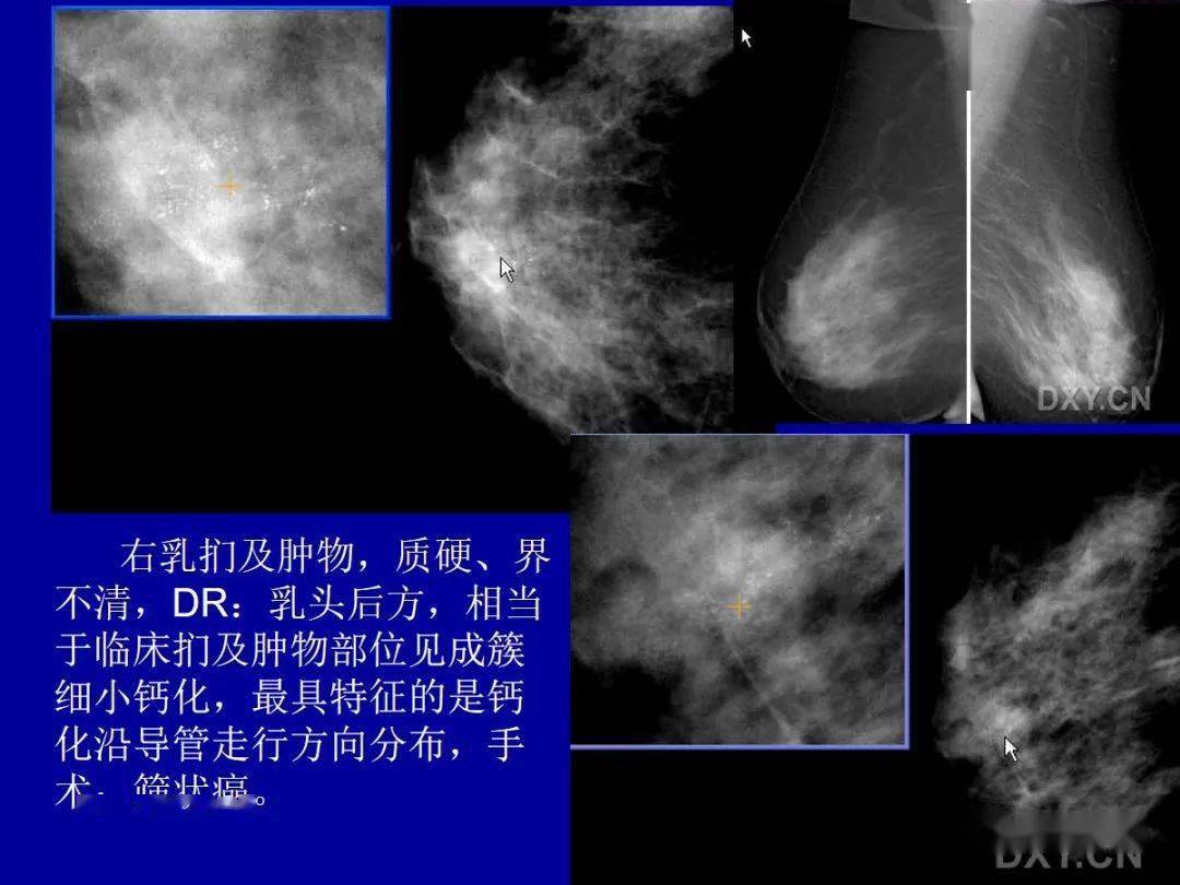 乳腺癌的影像診斷