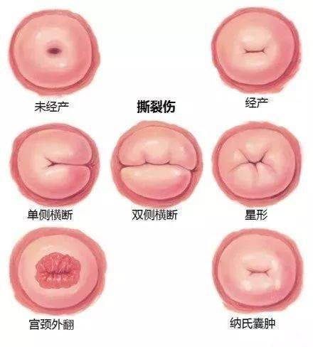 21,宫颈口形态正常变异20,各种常见子宫畸形19,第一产程宫颈扩张程度
