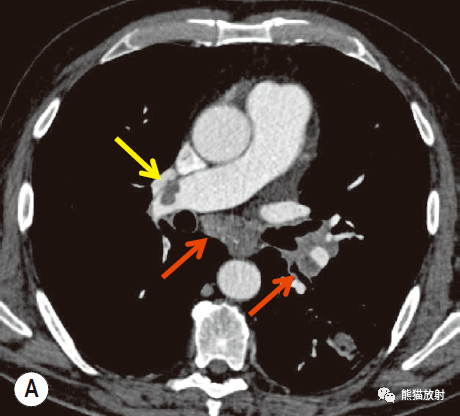格艾选读丨急性肺动脉血栓栓塞症机理及影像表现
