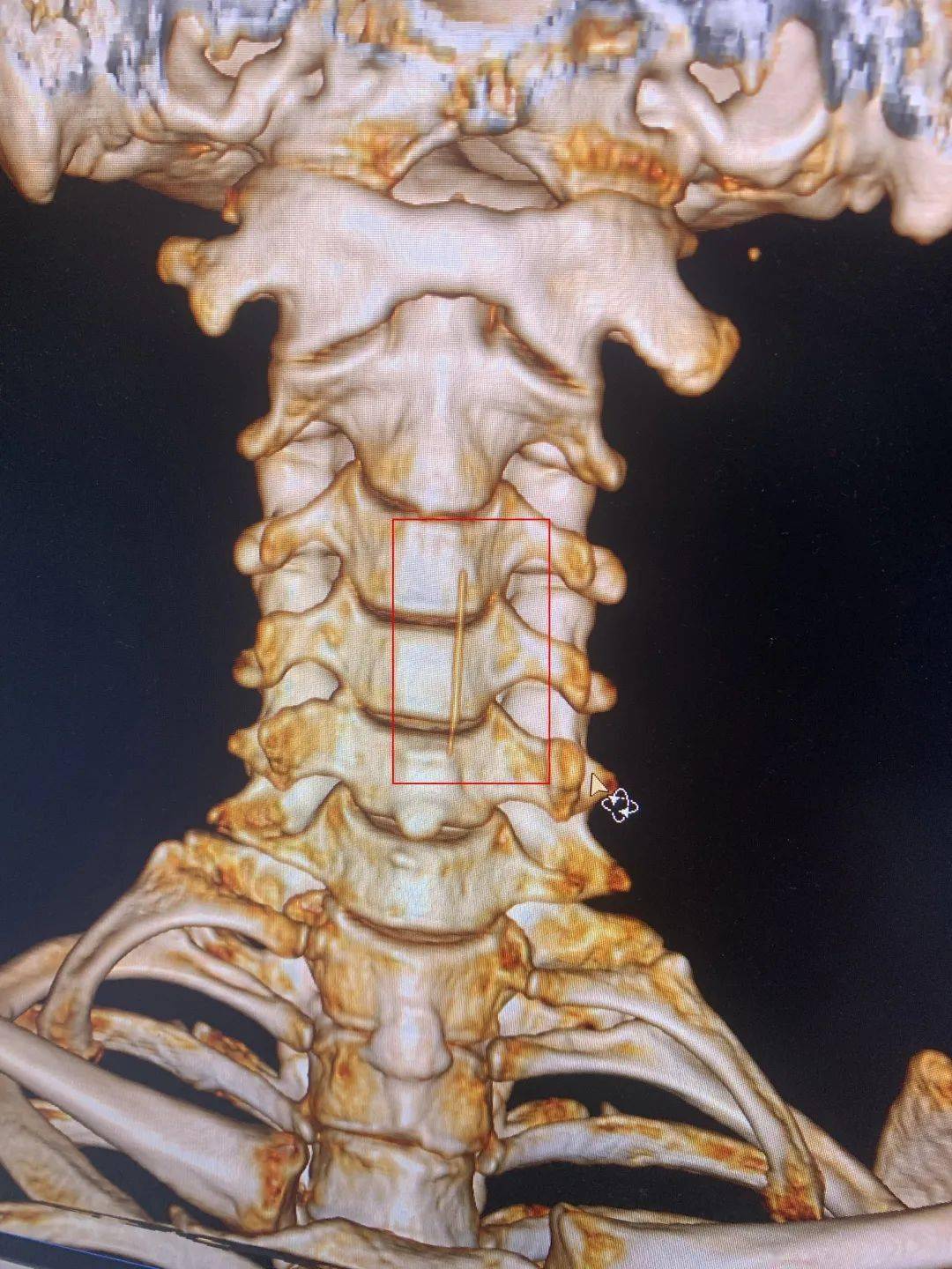 ct三维重建ct已经来到了食道口下端通过ct发现骨头通过咽后壁刺入黏膜