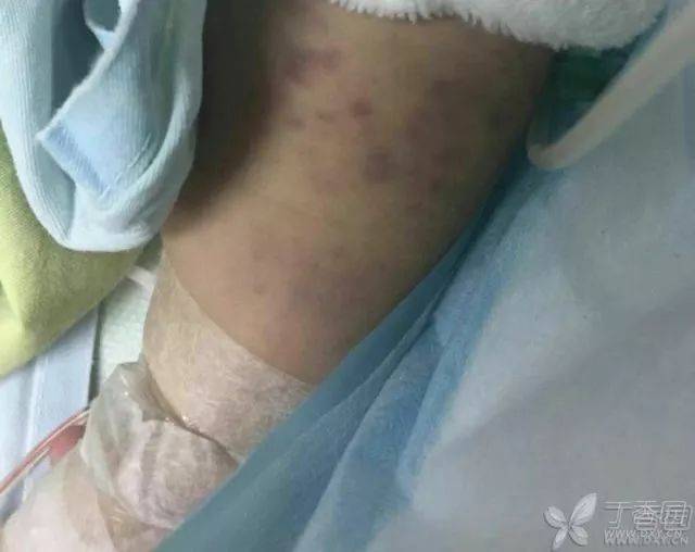 如患儿出现 dic,应及时治疗,输注新鲜冰冻血浆,冷沉淀,血小板等改善