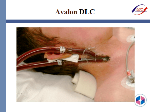 pptecmo插管技术与部位选择