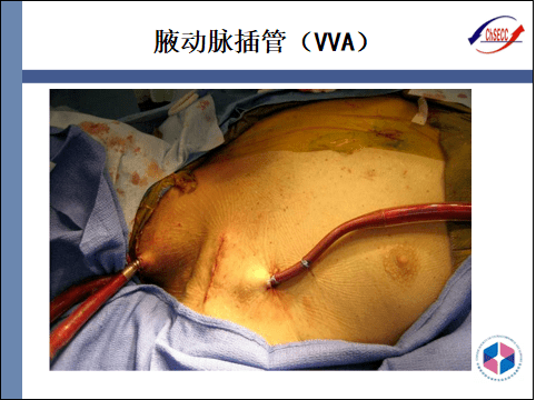 pptecmo插管技术与部位选择