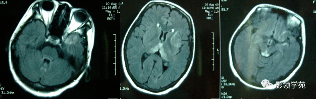 wernicke脑病mri表现