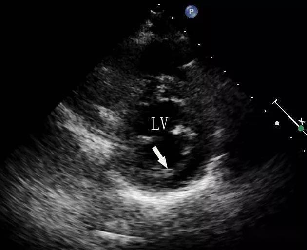 心内膜胶原弹力纤维增生症 (endocardial fibroelastosis,efe) 是指心