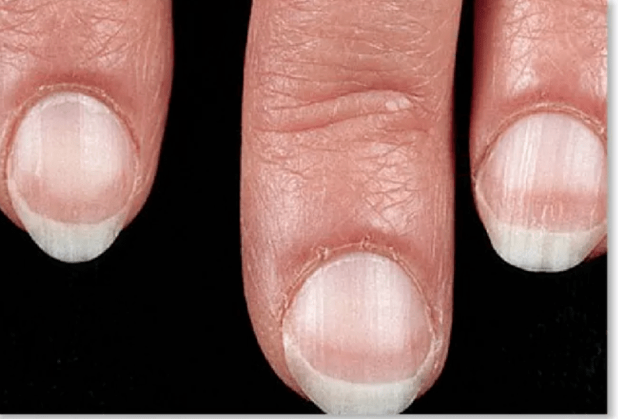 指甲上月牙小的人就是不健康的吗?快来看看吧!