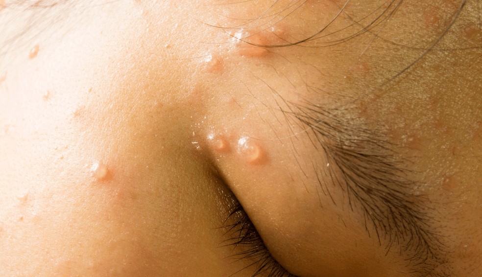 已有学校全班停课!_水痘