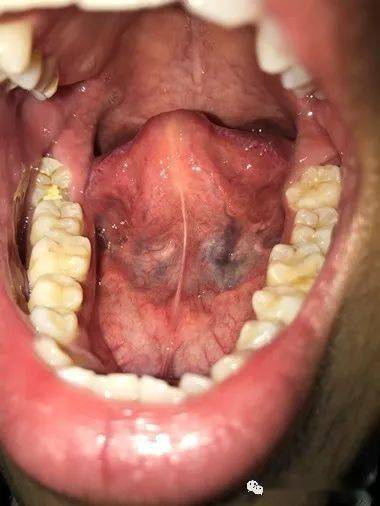 舌下腺管口图片图片