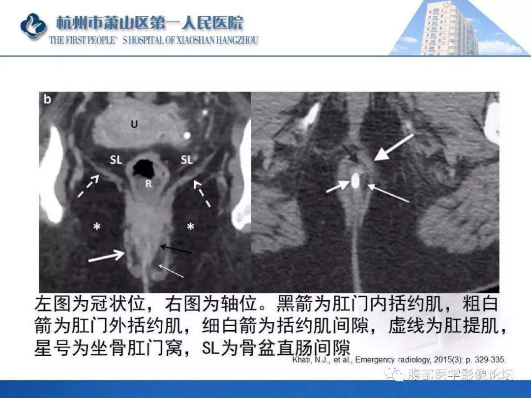 肛瘘mri诊断_括约肌