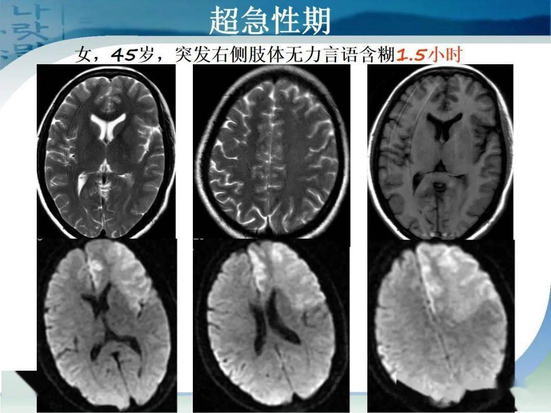 脑梗核磁图片解说图图片